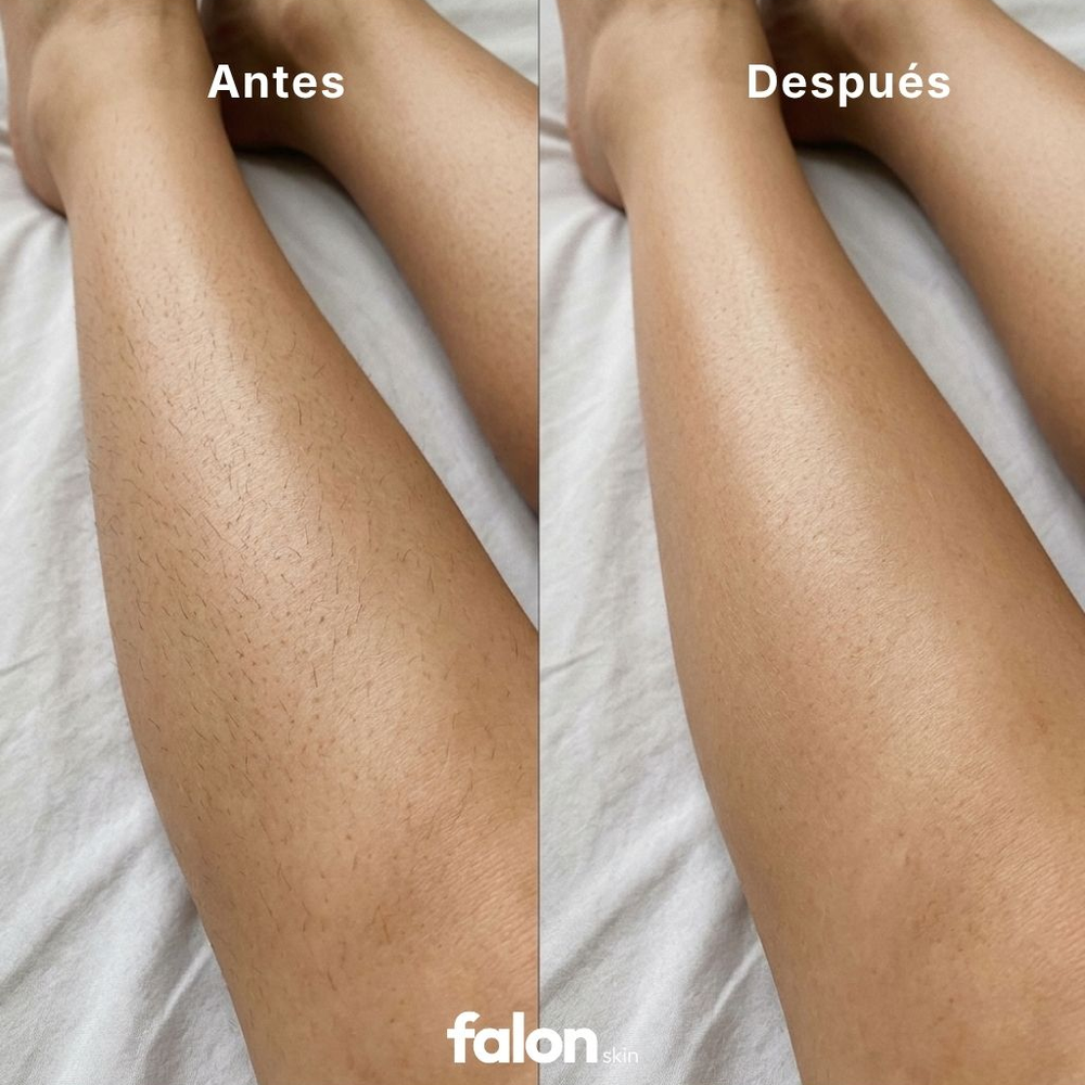 Falon Shinny Skin — Depiladora Definitiva IPL
